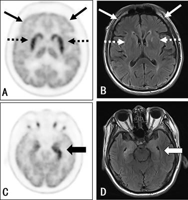 Subcortical Hypermetabolism Associated With Cortical Hypometabolism Is a Common Metabolic Pattern in Patients With Anti-Leucine-Rich Glioma-Inactivated 1 Antibody Encephalitis